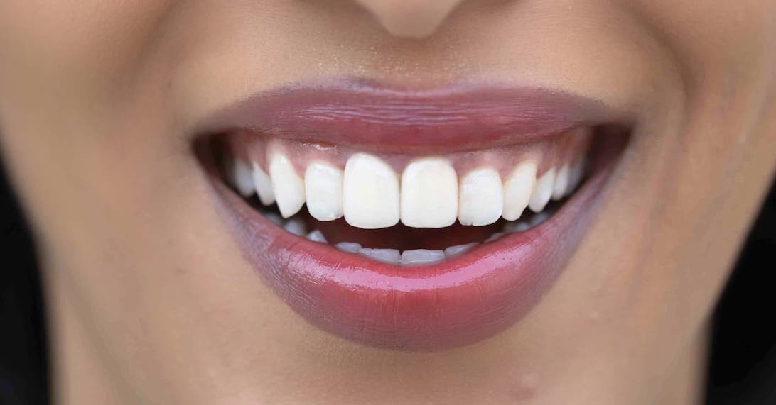 clear aligners luxury lifestyle